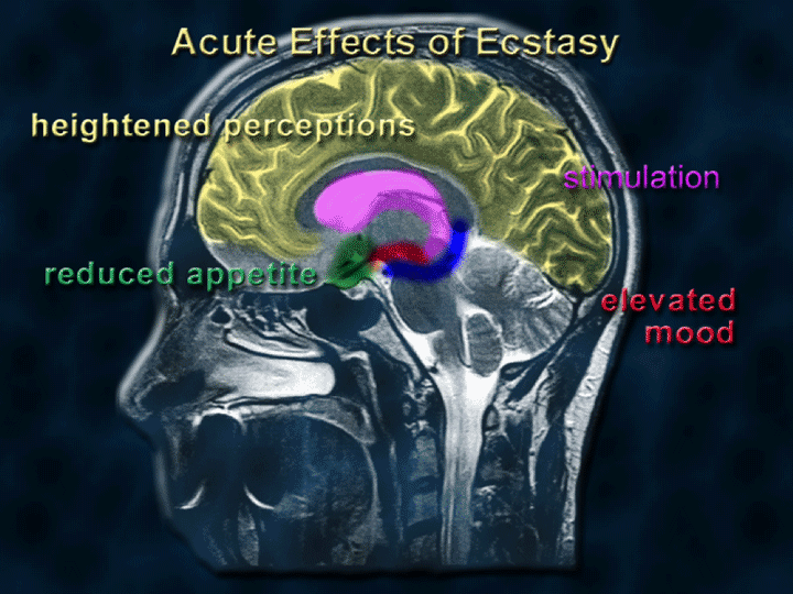 Ecstasy Brain Damage